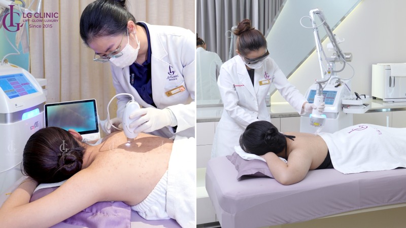 Mụn đầu đen ở lưng