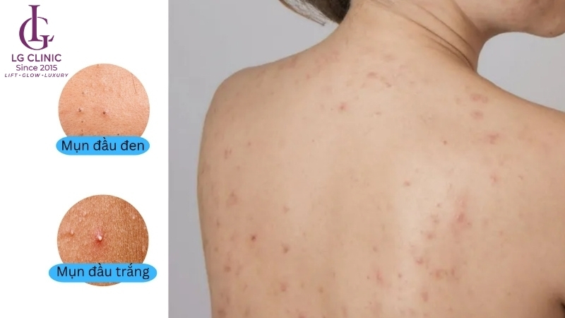 mụn lưng đầu trắng và đầu đen