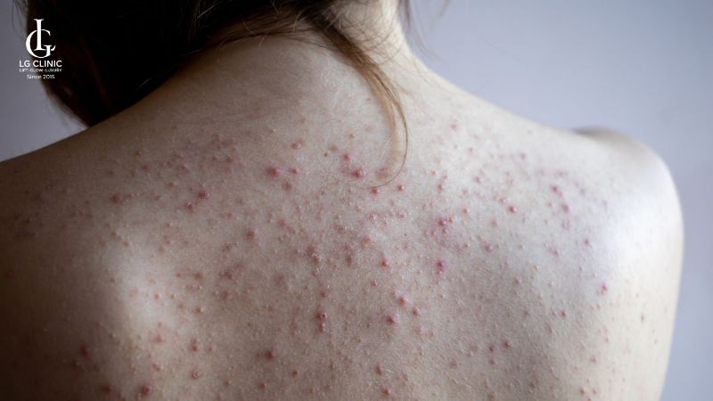 mụn lưng do đâu