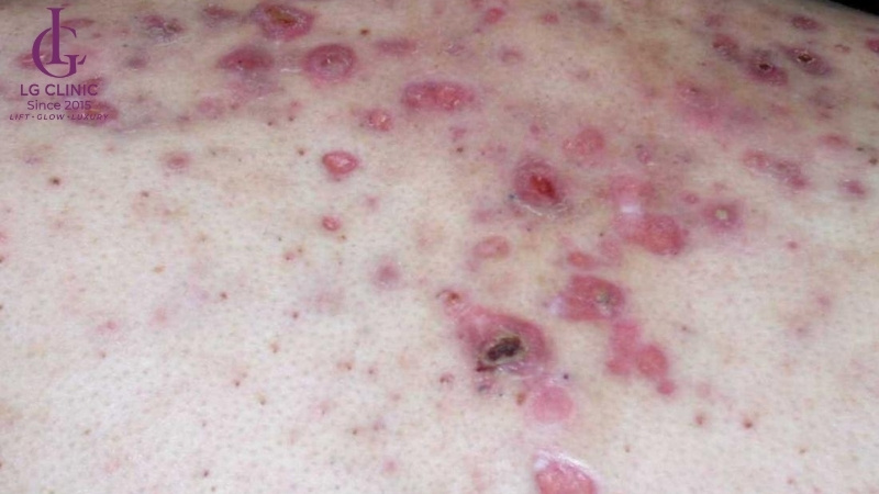 mụn lưng gây sẹo và tăng sắc tố