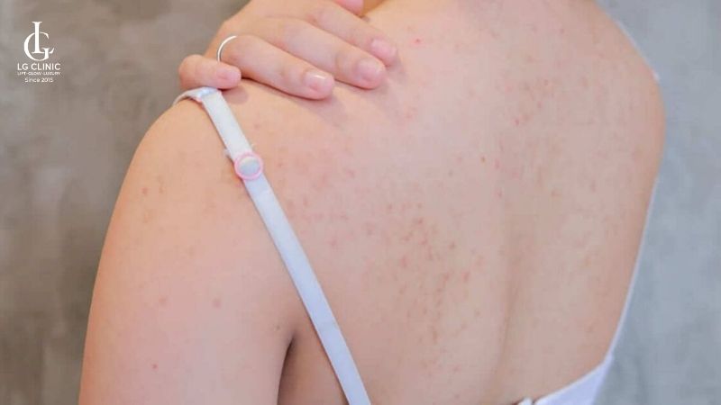 mụn lưng tuổi dậy thì