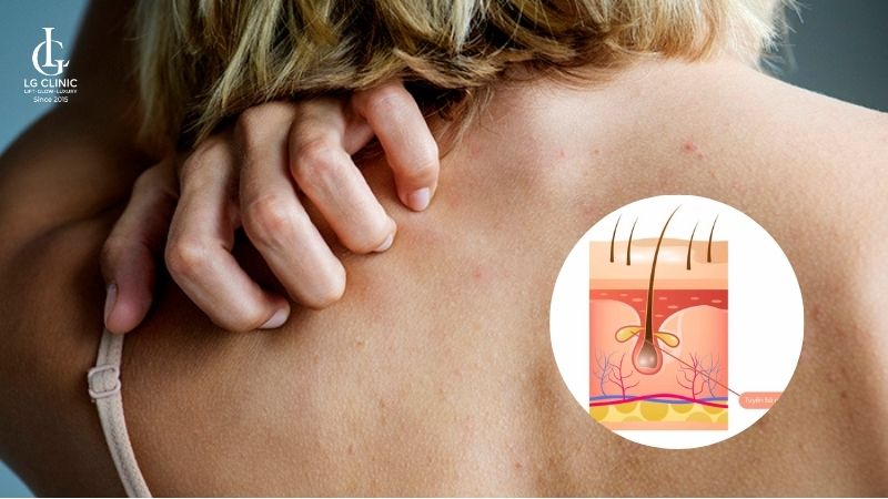 mụn lưng tuổi dậy thì