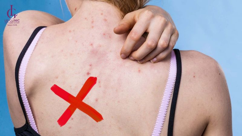 mụn lưng tuổi dậy thì