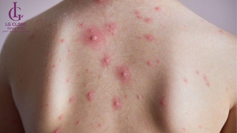 mụn mủ nặng ở lưng