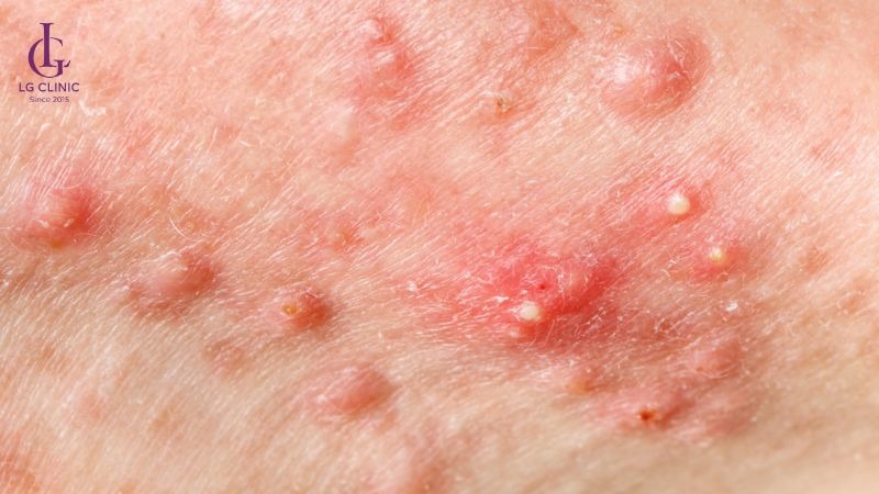 mụn ở nách nặn ra có mùi hôi​