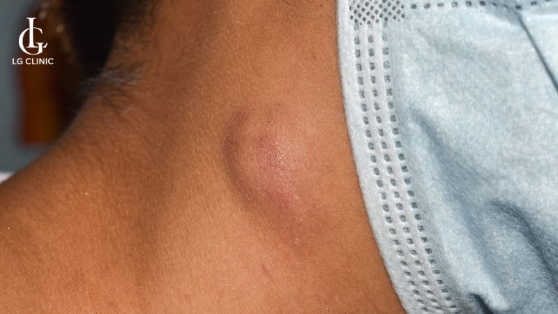 mụn ở nách nặn ra có mùi hôi​