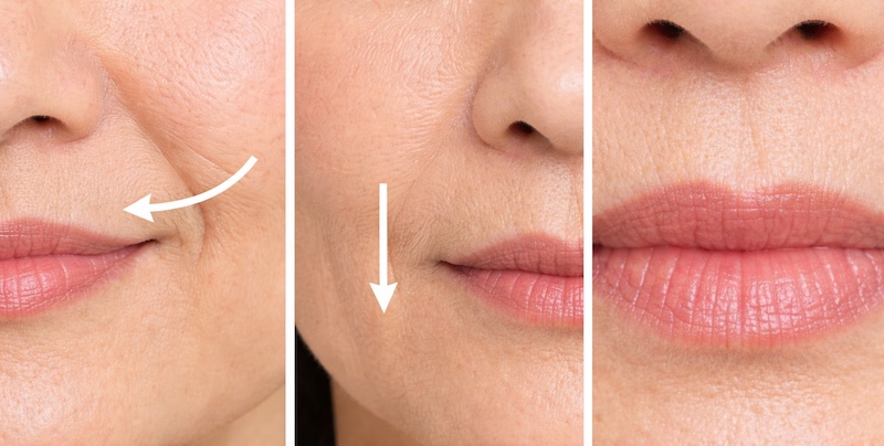 nếp nhăn khóe miệng