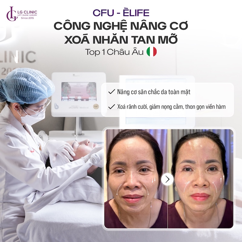 xóa mờ nếp nhăn quanh khóe miệng bằng cfu èlife