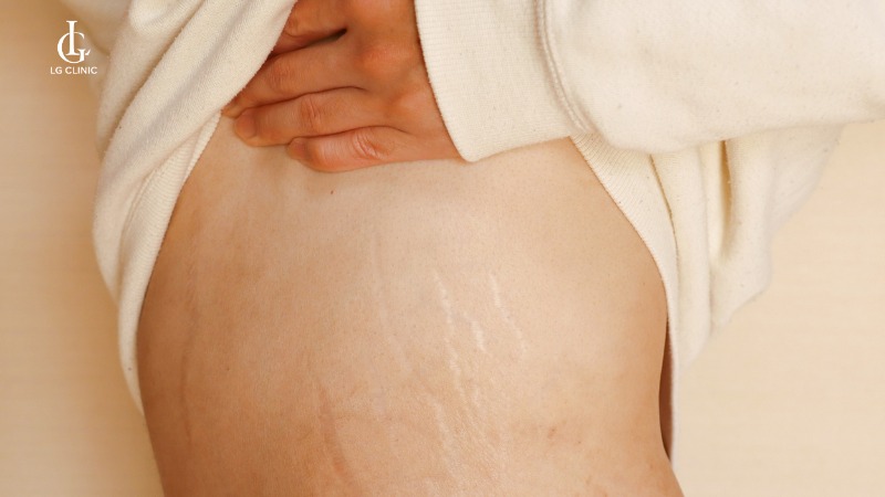 nguyên nhân bị rạn da