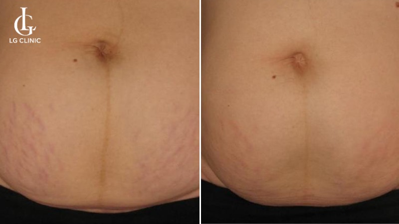 nguyên nhân bị rạn da