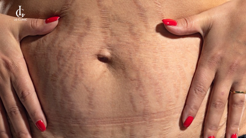 nguyên nhân bị rạn da