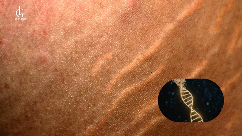 nguyên nhân bị rạn da