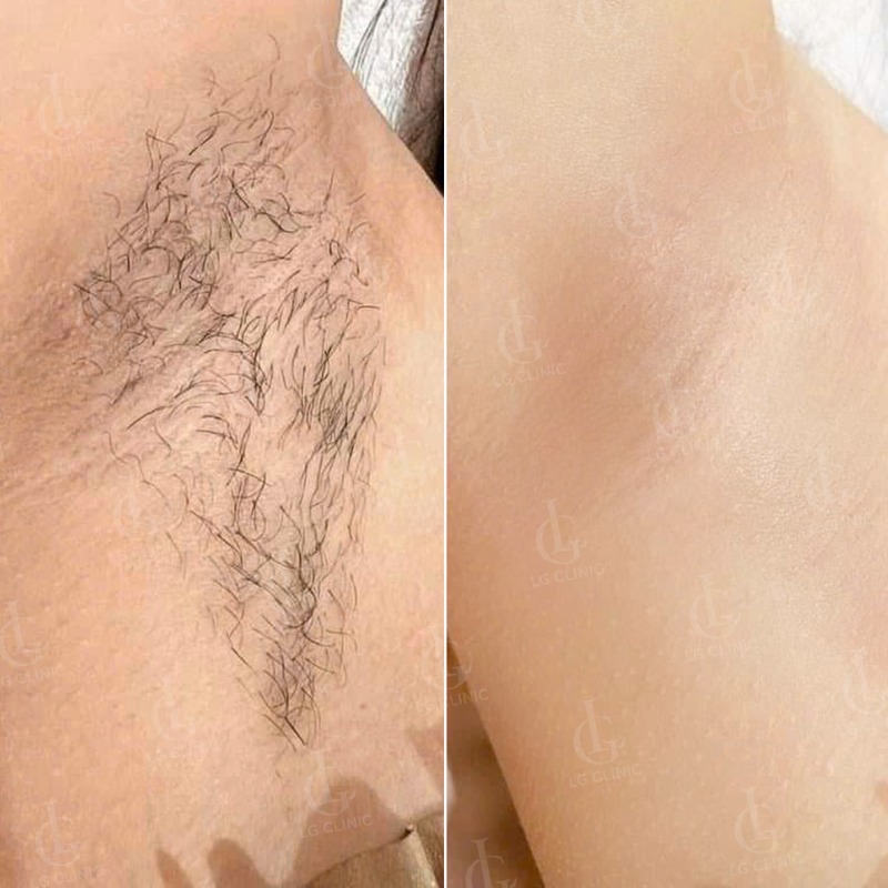 nguyên nhân gây hôi nách