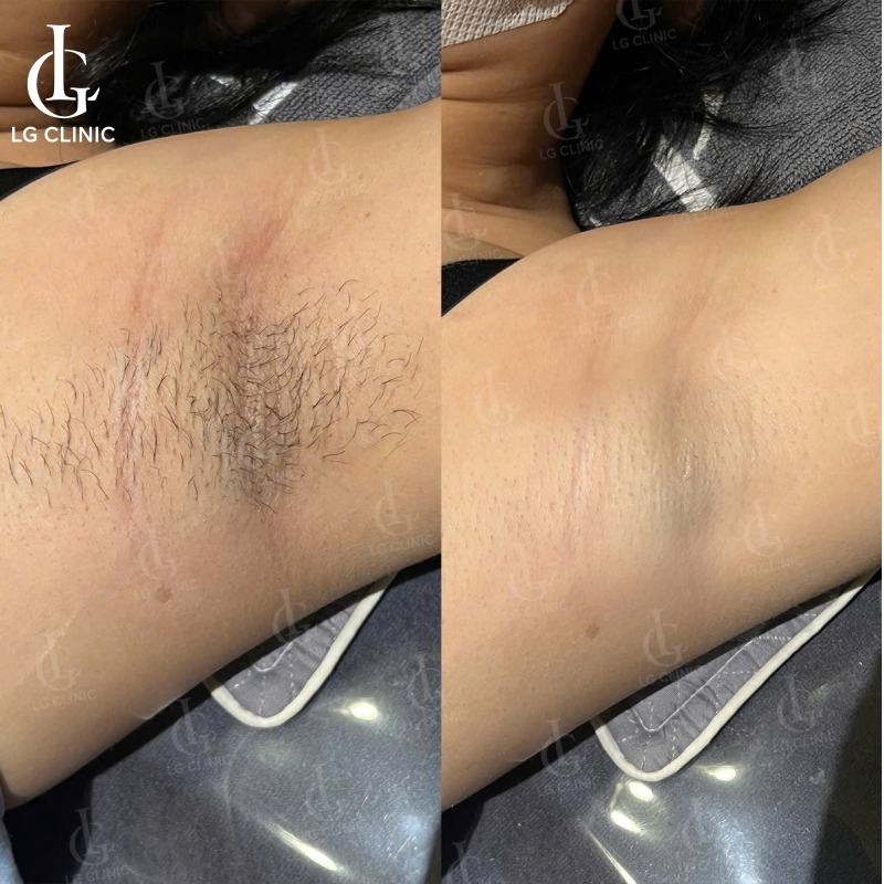 nguyên nhân gây hôi nách