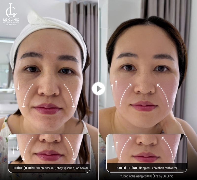 xoá rãnh cười bằng cfu èlife