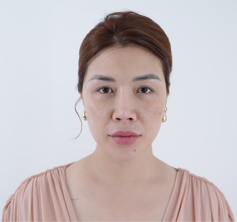 rãnh cười sâu