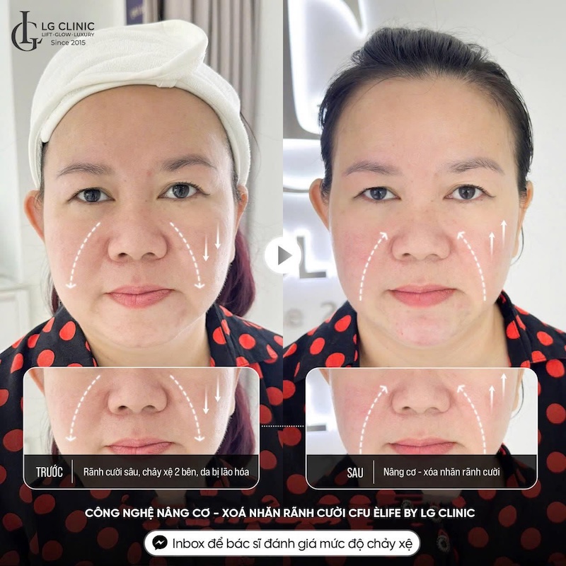 xoá rãnh cười sâu