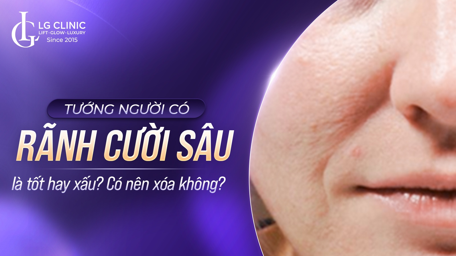 Rãnh cười sâu có ý nghĩa gì? Có nên xóa không?