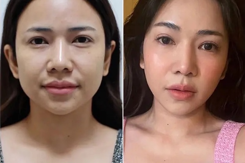 kết quả tiêm rãnh cười