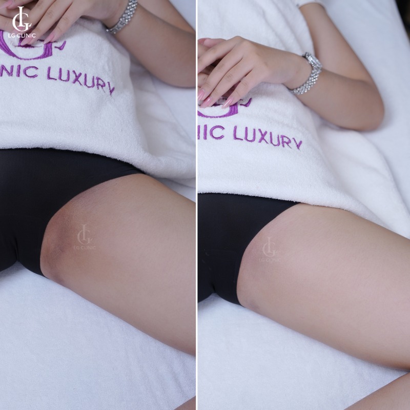 spa trị thâm quận 7