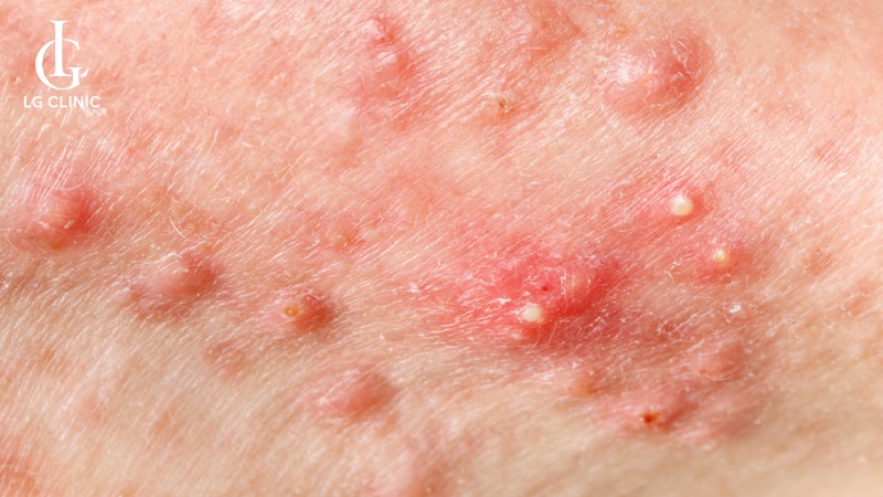 Tại sao lại nổi mụn ở nách
