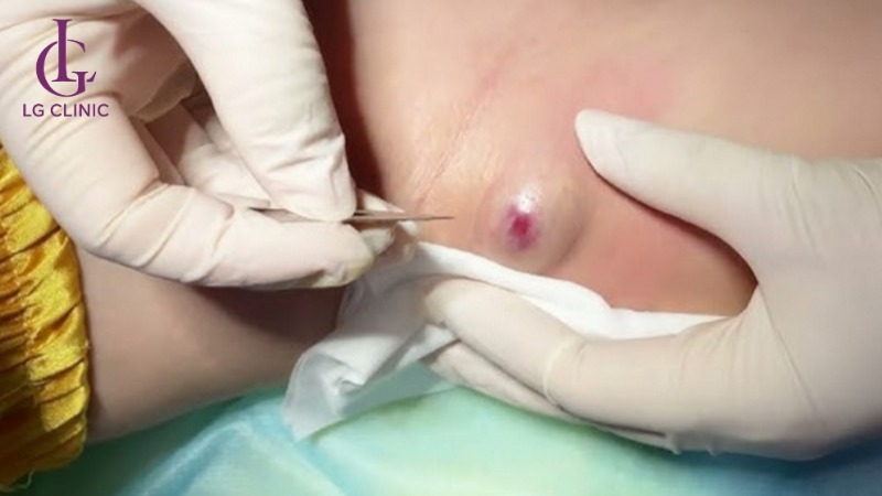 Tại sao lại nổi mụn ở nách