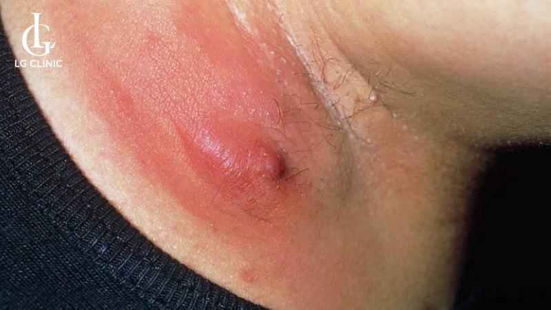 Tại sao lại nổi mụn ở nách