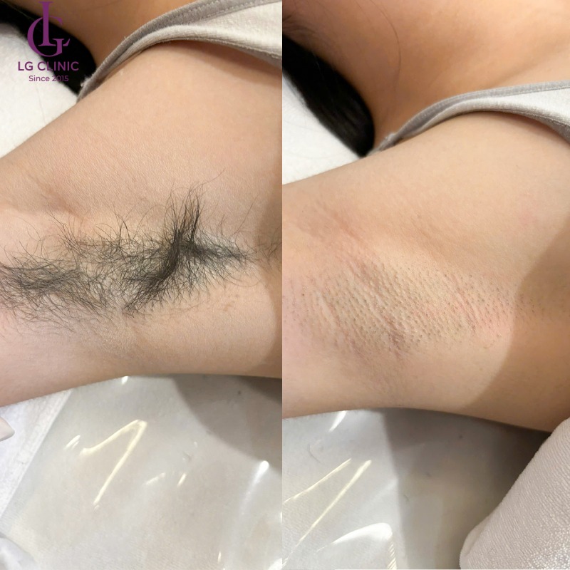 Tại sao lại nổi mụn ở nách