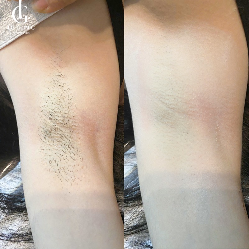 Tại sao lại nổi mụn ở nách