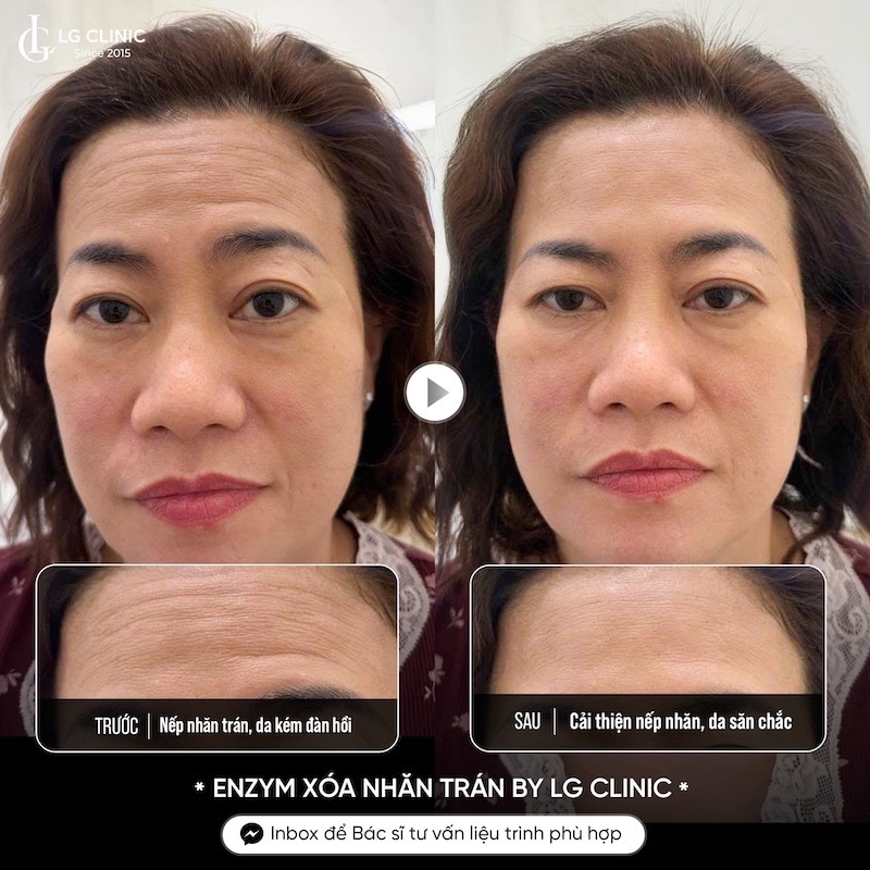 xoá nếp nhăn trán