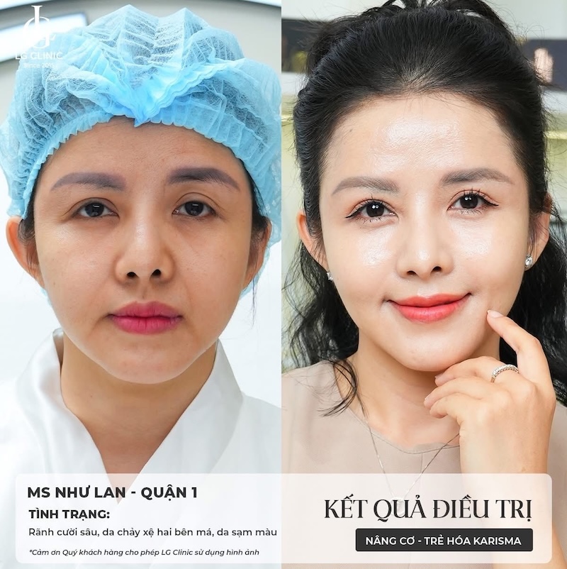 tiêm trẻ hoá xoá nhăn