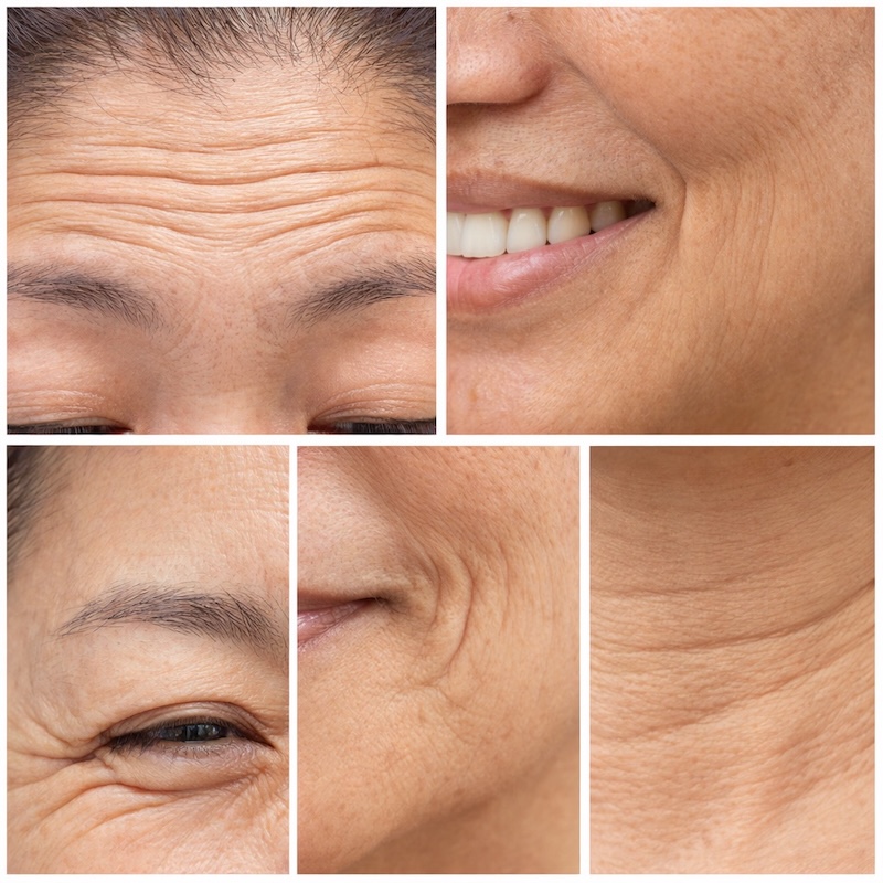 các vị trí nếp nhăn