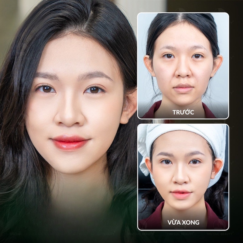 tiêm chất làm đầy xóa nếp nhăn