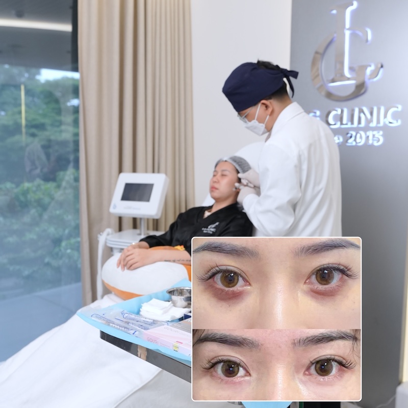 tiêm chất làm đầy xóa nếp nhăn