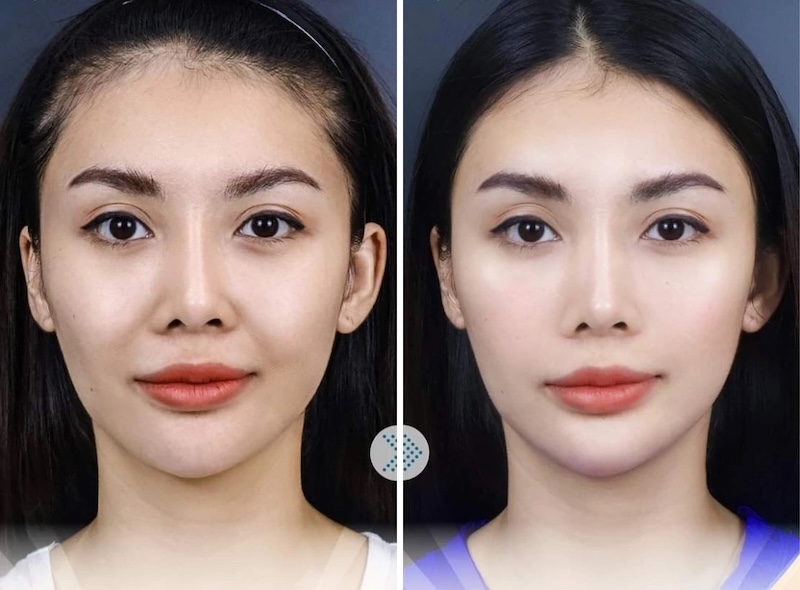 kết quả tiêm ha rãnh cười