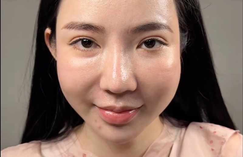 biến chứng tiêm rãnh cười