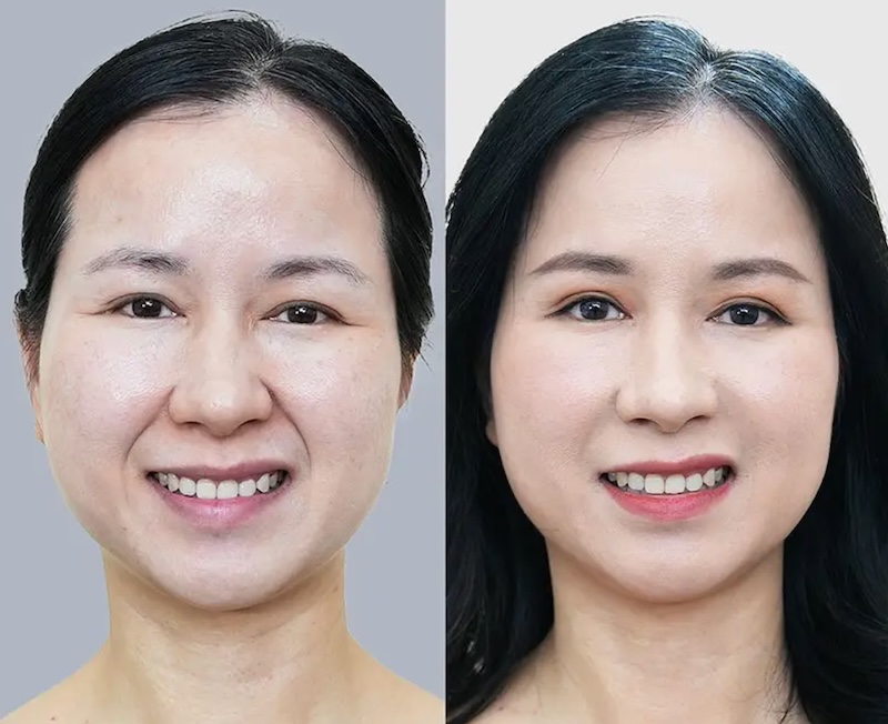 Tiêm rãnh cười bị đơ