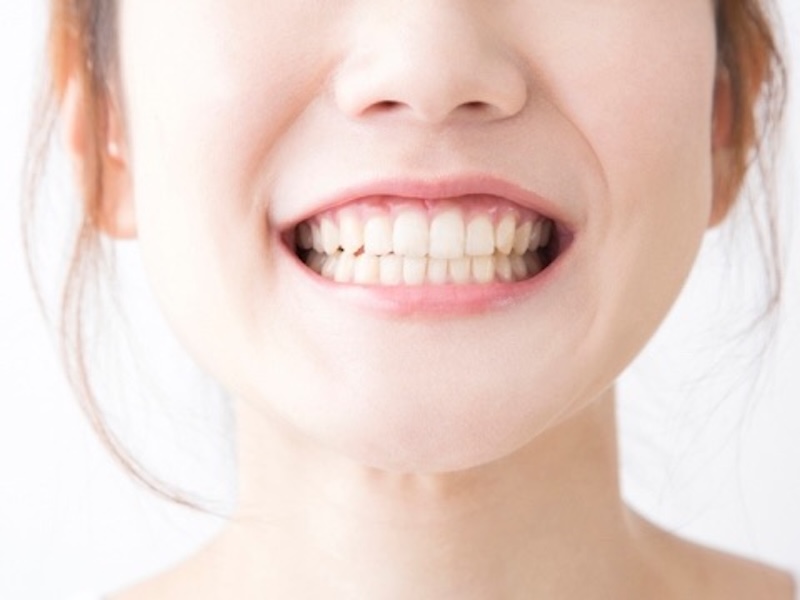 lưu ý khi tiêm rãnh cười