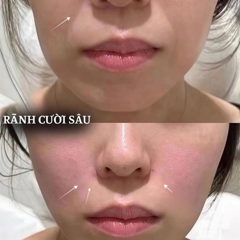 tác dụng phụ tiêm rãnh cười