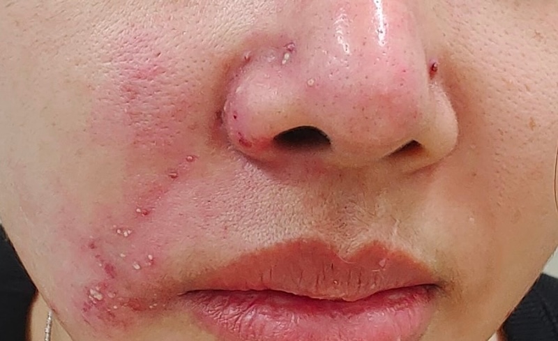 biến chứng tiêm rãnh cười