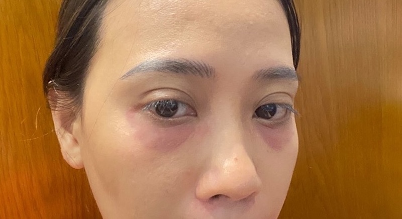 tác dụng phụ khi tiêm mắt