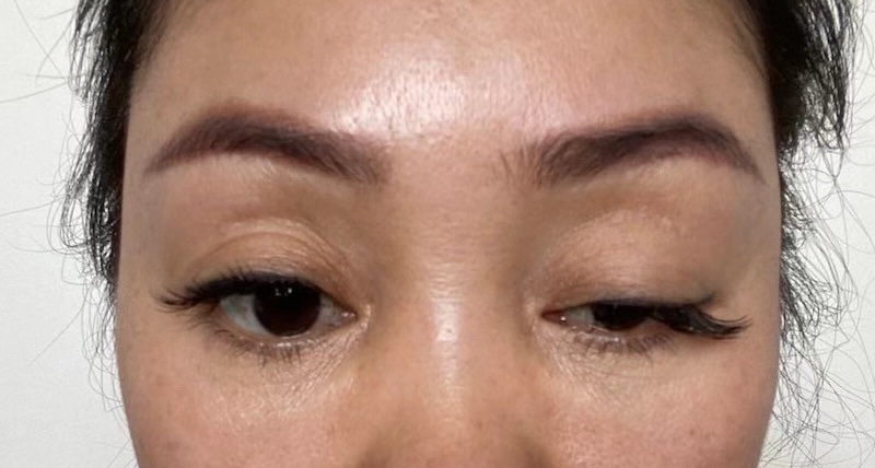 biến chứng tiêm botox