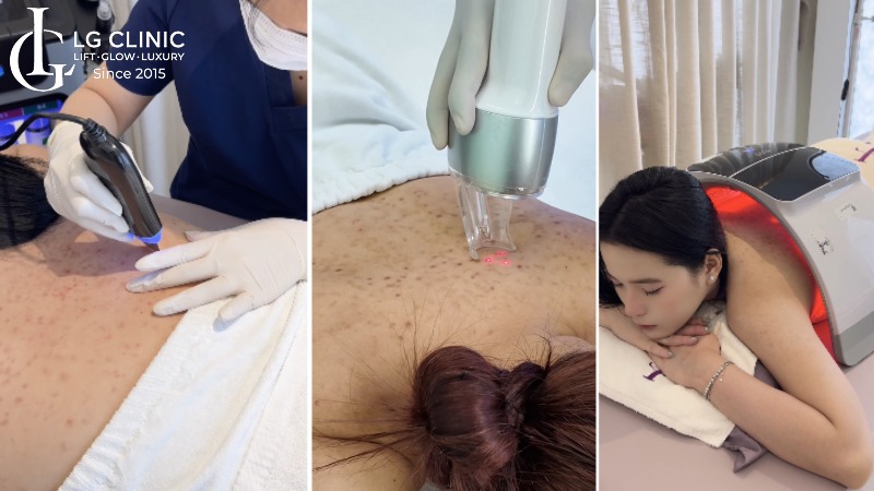 Trị mụn lưng giá bao nhiêu