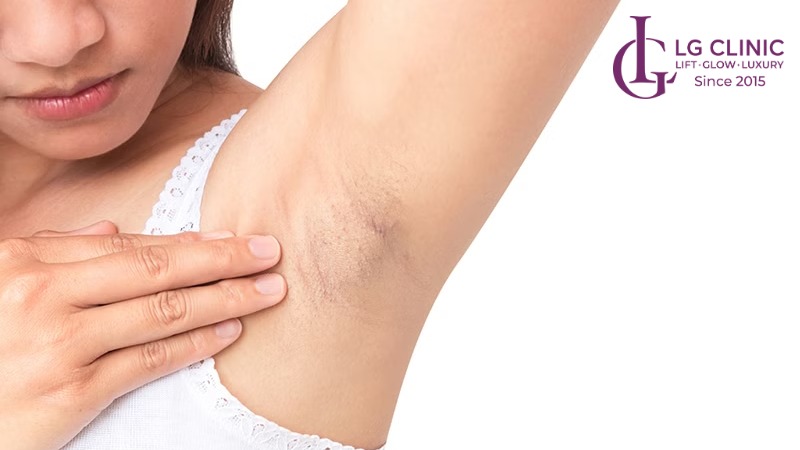 Wax lông nách có mọc lại không