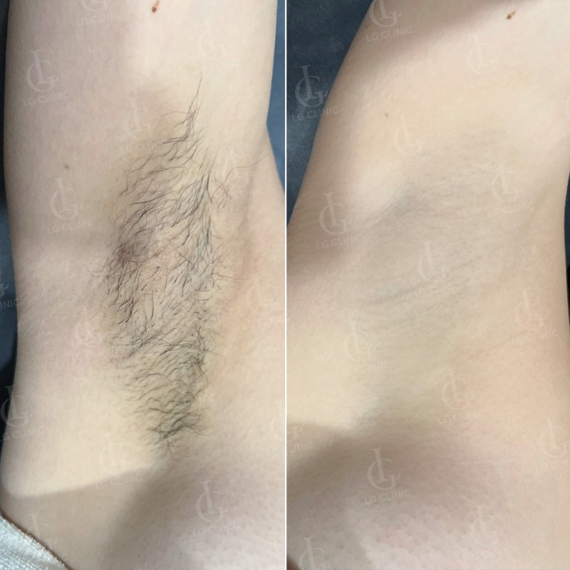 Wax lông nách có mọc lại không