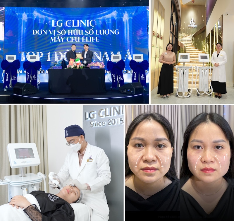 xoá nhăn bằng cfu èlife tại lg clinic