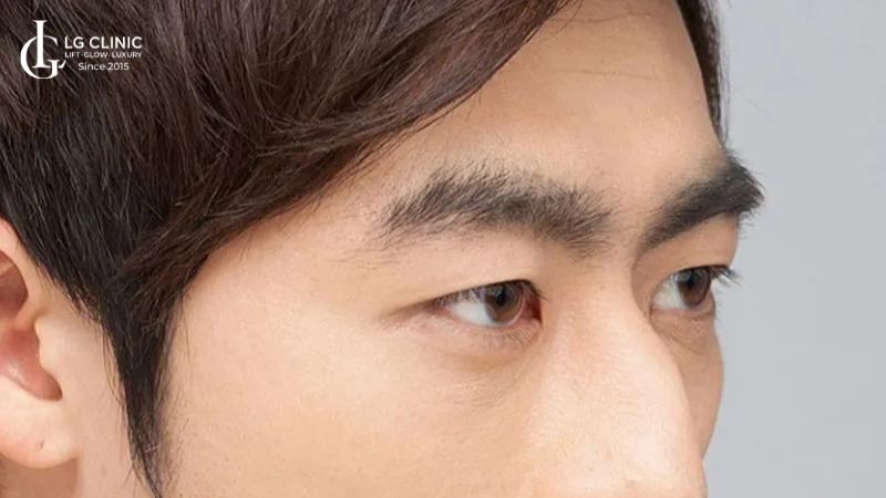 Ấn đường hẹp
