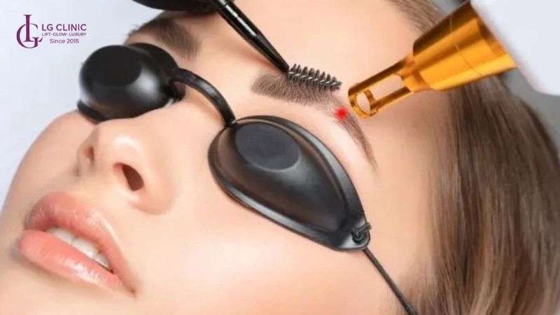 Cải thiện ấn đường hẹp bằng thẩm mỹ