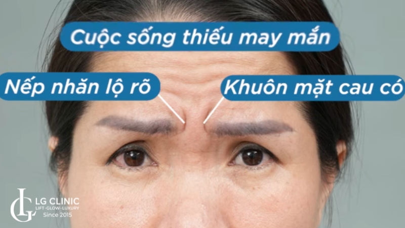 Ấn đường nhiều nếp nhăn là dấu hiệu của lão hoá, vất vả