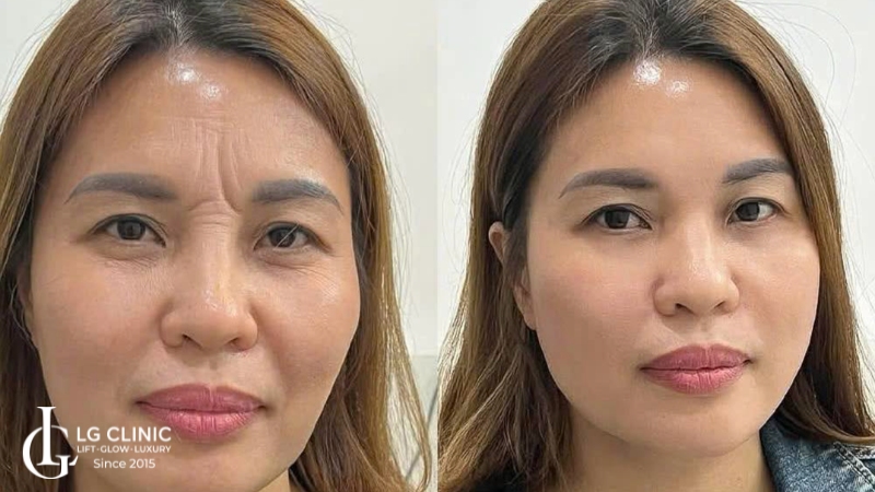 Xoá nhăn ấn đường để làm trẻ hoá khuôn mặt